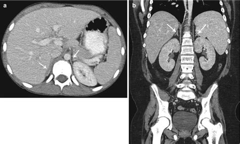 Adrenal Gland Anatomy Ct