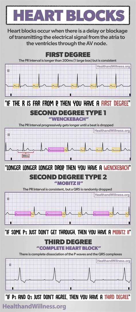 How to Read an EKG Rhythm Strip | Health And Willness