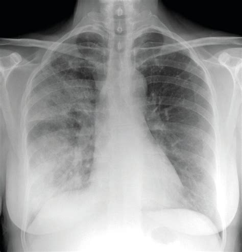 Death rates from community acquired pneumonia falling in NHS hospitals ...