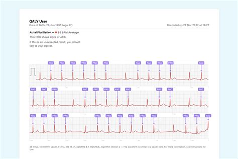 What Ectopic Atrial Rhythm Looks Like on Your Watch ECG | Qaly