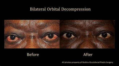 Orbital Surgery | Plastic Surgeon | Parbhu Oculofacial Plastic Surgery