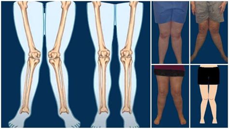 Knock Knee: Causes, Symptoms, Diagnosis and Treatment