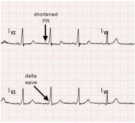 Tachyarrhythmia in Wolff-Parkinson-White Syndrome - The Western Journal ...