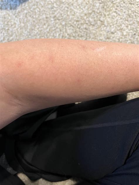 Weird Small Sores on Arms : r/lupus