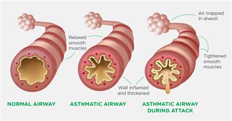 How to Treat Asthma Attacks in Kids | Children's Healthcare of Atlanta