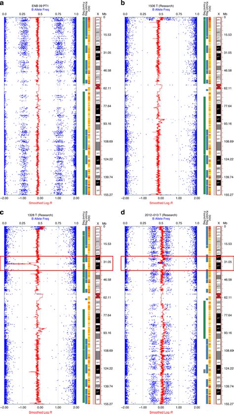 SNP array analysis of X chromosomes in representative ONB tumor ...