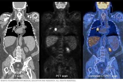 Positron emission tomography scan - Mayo Clinic