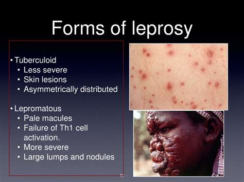 PPT - Leprosy PowerPoint Presentation - ID:3060390