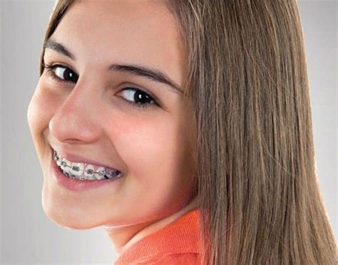 types of braces | Types of braces, Different types of braces, Kids braces