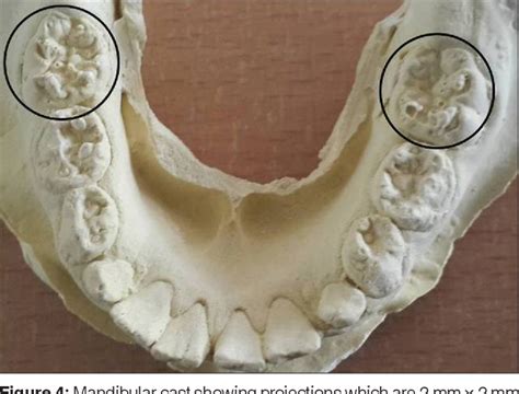 Nonsyphilitic occurrence of mulberry molars: A rare case report ...