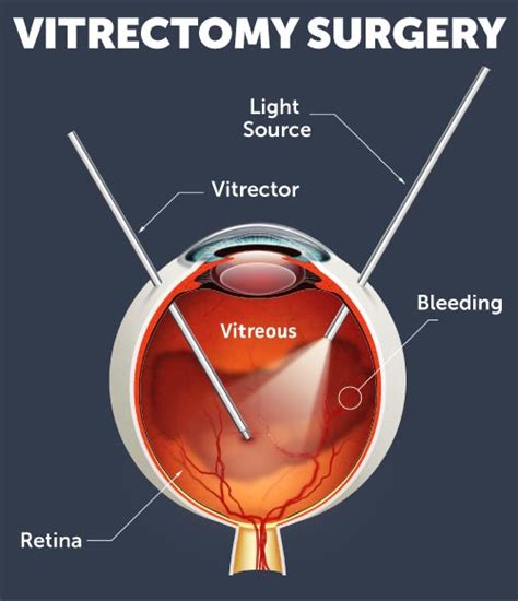 What Is Retina Surgery (Vitrectomy)?