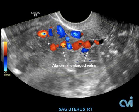 Pelvic Congestion Syndrome - Pelvic Pain Embolization Treatment