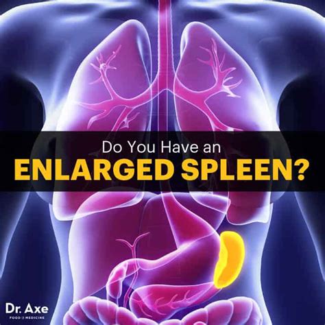 Enlarged Spleen Symptoms, Warning Signs + 5 Treatments - Dr. Axe