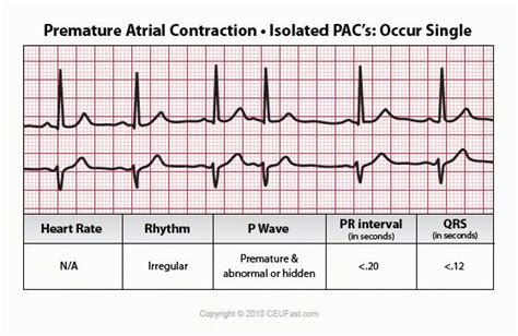 Premature Atrial Contraction Acute Nursing, Nursing Ceu, Cath Lab ...