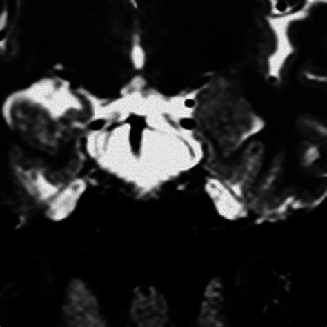 T2-weighted MRI, coronal section, showing right hippocampal atrophy in ...