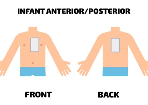 Infant AED Pads: Everything You Need To Know | Heartsmart.com