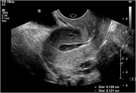 Sonohysterographic measurement of endometrial thickness