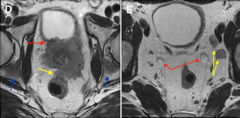 Prostate cancer - MRI - Radiology at St. Vincent's University Hospital