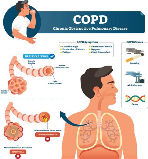 Chronic Obstructive Pulmonary Disease | COPD Treatment London