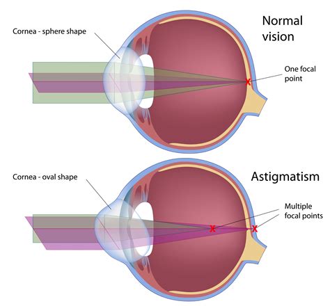 Astigmatism | Petrou Eye Care