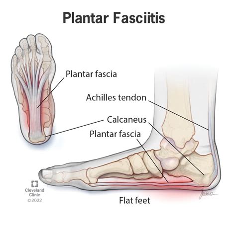 Gruß Konzept Klavier spielen plantar fasciitis heel Braun Buchhalter ...