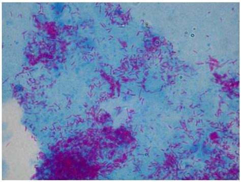 Ziehl-Neelsen acid-fast staining procedure | Medical Laboratories