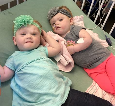 Formerly Conjoined Twins Thriving Five Months After Surgery | PEOPLE.com