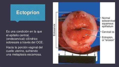 Cervical Ectropion Cervix