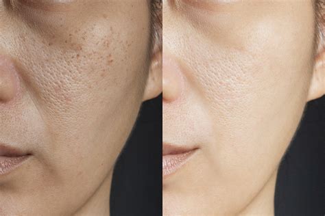 The Deal About Enlarged Pores: Causes & Treatment Options