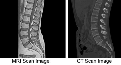 MRI vs. CT Scan; Diagnosing Spine & Neck Injuries & Degenerative Diseases