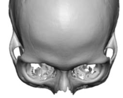 female brow bone anatomy top view 3D CT scan Dr Barry Eppley ...