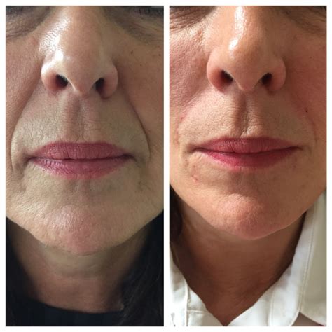 Dermal filler before and after #drhanna #filler Best Lip Gloss, Diy Lip ...