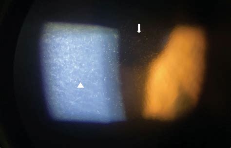 The Consequences of Corneal Endothelial Compromise