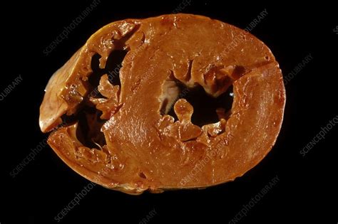 Cardiac amyloidosis - Stock Image - C023/5511 - Science Photo Library