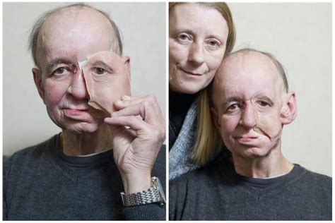 Disfigured cancer survivor gets 3-D-printed face