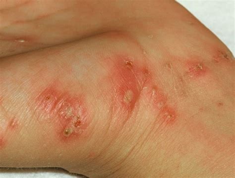 👉 Scabies Rash - Pictures, Symptoms, Treatment, Causes (February 2022)