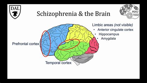 Schizophrenia Brain Vs Normal Brain