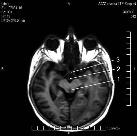 Section of mesencephalon at the level of hiatus tentorii obtained by ...