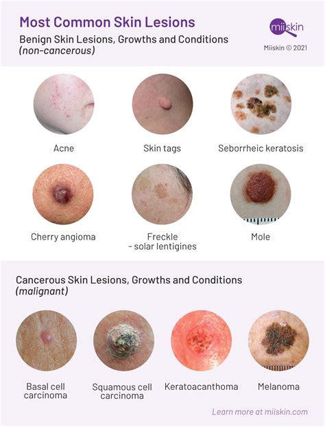 Skin Cancer Types Chart