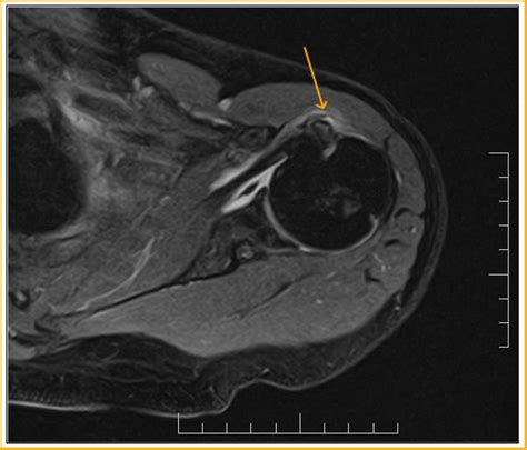 Long Head Biceps Tear-MRI - Sumer's Radiology Blog