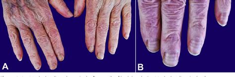 Figure 1 from Muehrcke’s lines | Semantic Scholar