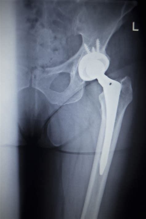 New DePuy Hip Implant Lawsuit Joins MDL in Dallas - Top Class Actions