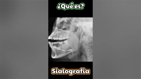 ¿QUE ES LA SIALOGRAFIA? ☢ #shorts #radiologia - YouTube