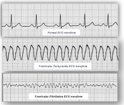 Type of heart rhythms for classification using the proposed method ...