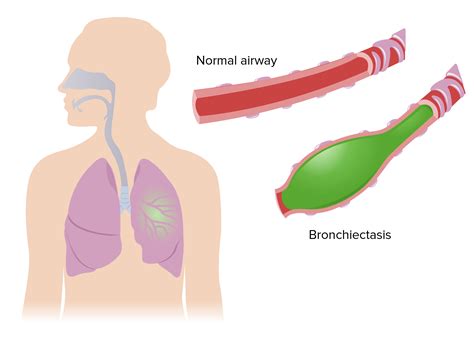 Bronchiectasis | Concise Medical Knowledge