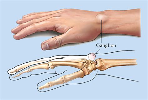 What Is A Ganglion Cyst Causes Symptoms And Treatments | Images and ...