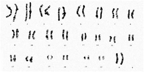 How a female X chromosome is inactivated