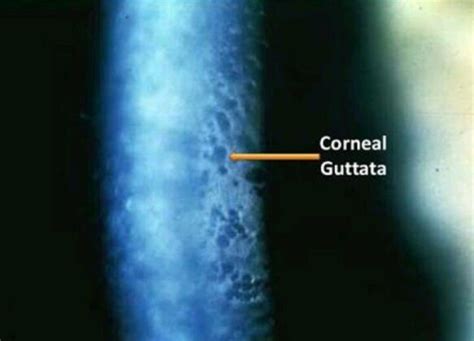 Cornea Guttata: Symptoms And Treatment | How Relate To Phaco