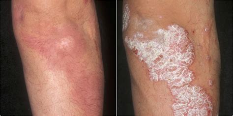 Psoriasis: new treatments, excellent results | Minnesota Spokesman-Recorder