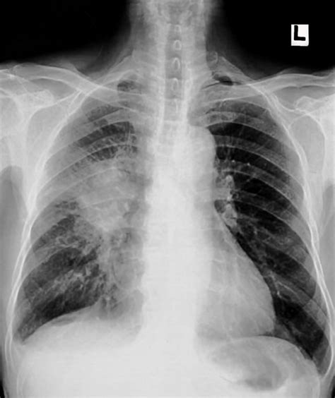 Asbestos Lung Cancer Lawsuits | Free Case Evaluation